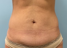 Tummy Tuck Before Photo by Julia Spears, MD, FACS; Marlton, NJ - Case 49844 Tummy Tuck Before Photo by Julia Spears, MD, FACS; Marlton, NJ - Case 49844