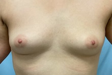 Breast Augmentation Before Photo by Julia Spears, MD, FACS; Marlton, NJ - Case 49853 Breast Augmentation Before Photo by Julia Spears, MD, FACS; Marlton, NJ - Case 49853