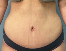 Tummy Tuck After Photo by Julia Spears, MD, FACS; Marlton, NJ - Case 49854 Tummy Tuck After Photo by Julia Spears, MD, FACS; Marlton, NJ - Case 49854