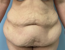 Tummy Tuck Before Photo by Julia Spears, MD, FACS; Marlton, NJ - Case 49854 Tummy Tuck Before Photo by Julia Spears, MD, FACS; Marlton, NJ - Case 49854