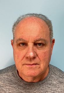 Facelift Before Photo by Julia Spears, MD, FACS; Marlton, NJ - Case 49993 Facelift Before Photo by Julia Spears, MD, FACS; Marlton, NJ - Case 49993
