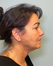 Facelift After Photo by Julia Spears, MD, FACS; ,  - Case 50210