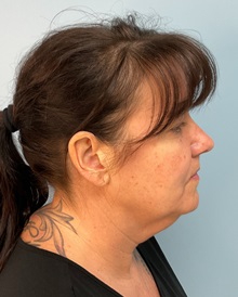 Facelift Before Photo by Julia Spears, MD, FACS; ,  - Case 50210