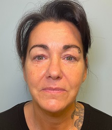 Facelift After Photo by Julia Spears, MD, FACS; ,  - Case 50210