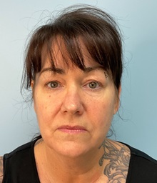 Facelift Before Photo by Julia Spears, MD, FACS; ,  - Case 50210