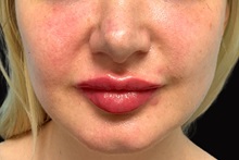 Dermal Fillers After Photo by Julia Spears, MD, FACS; ,  - Case 50232