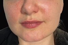 Dermal Fillers Before Photo by Julia Spears, MD, FACS; ,  - Case 50232