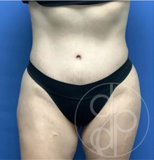 Tummy Tuck After Photo by Danielle DeLuca-Pytell, MD; Troy, MI - Case 47686