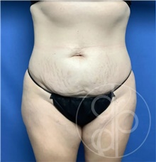 Tummy Tuck Before Photo by Danielle DeLuca-Pytell, MD; Troy, MI - Case 47686