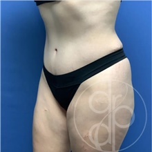 Tummy Tuck After Photo by Danielle DeLuca-Pytell, MD; Troy, MI - Case 47686