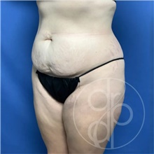 Tummy Tuck Before Photo by Danielle DeLuca-Pytell, MD; Troy, MI - Case 47686