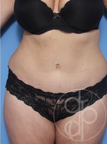 Tummy Tuck After Photo by Danielle DeLuca-Pytell, MD; Troy, MI - Case 47777