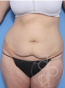 Tummy Tuck Before Photo by Danielle DeLuca-Pytell, MD; Troy, MI - Case 47777