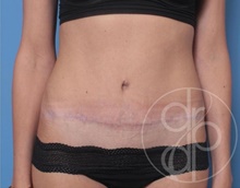 Tummy Tuck After Photo by Danielle DeLuca-Pytell, MD; Troy, MI - Case 47779