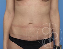 Tummy Tuck Before Photo by Danielle DeLuca-Pytell, MD; Troy, MI - Case 47779