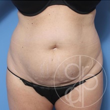 Tummy Tuck Before Photo by Danielle DeLuca-Pytell, MD; Troy, MI - Case 47784