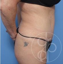 Tummy Tuck After Photo by Danielle DeLuca-Pytell, MD; Troy, MI - Case 47784