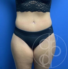 Tummy Tuck After Photo by Danielle DeLuca-Pytell, MD; Troy, MI - Case 47785