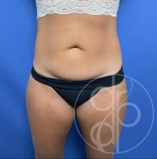 Tummy Tuck Before Photo by Danielle DeLuca-Pytell, MD; Troy, MI - Case 47785