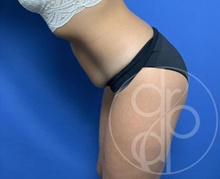 Tummy Tuck Before Photo by Danielle DeLuca-Pytell, MD; Troy, MI - Case 47785