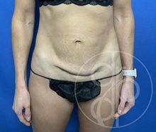Tummy Tuck Before Photo by Danielle DeLuca-Pytell, MD; Troy, MI - Case 47787