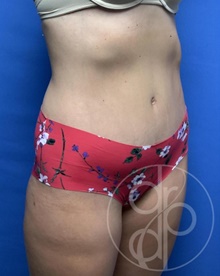 Tummy Tuck After Photo by Danielle DeLuca-Pytell, MD; Troy, MI - Case 47787