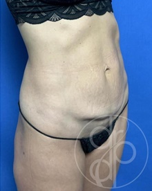 Tummy Tuck Before Photo by Danielle DeLuca-Pytell, MD; Troy, MI - Case 47787