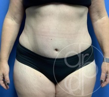 Tummy Tuck After Photo by Danielle DeLuca-Pytell, MD; Troy, MI - Case 47789