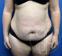 Tummy Tuck Before Photo by Danielle DeLuca-Pytell, MD; Troy, MI - Case 47789