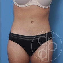 Tummy Tuck After Photo by Danielle DeLuca-Pytell, MD; Troy, MI - Case 47790