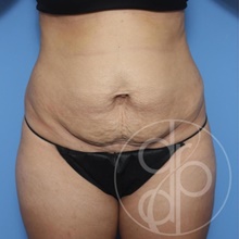 Tummy Tuck Before Photo by Danielle DeLuca-Pytell, MD; Troy, MI - Case 47790