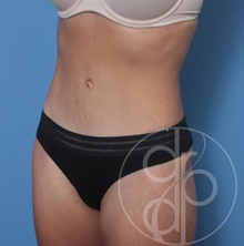 Tummy Tuck After Photo by Danielle DeLuca-Pytell, MD; Troy, MI - Case 47790