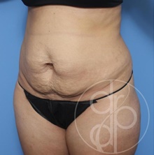 Tummy Tuck Before Photo by Danielle DeLuca-Pytell, MD; Troy, MI - Case 47790