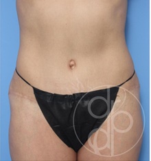 Tummy Tuck After Photo by Danielle DeLuca-Pytell, MD; Troy, MI - Case 47791