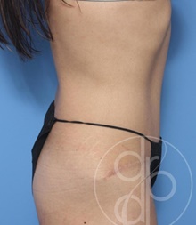 Tummy Tuck After Photo by Danielle DeLuca-Pytell, MD; Troy, MI - Case 47791