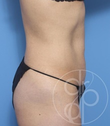 Tummy Tuck Before Photo by Danielle DeLuca-Pytell, MD; Troy, MI - Case 47791