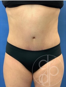 Tummy Tuck After Photo by Danielle DeLuca-Pytell, MD; Troy, MI - Case 47792