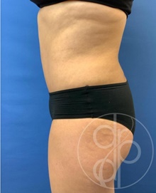 Tummy Tuck After Photo by Danielle DeLuca-Pytell, MD; Troy, MI - Case 47792