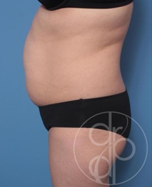 Tummy Tuck Before Photo by Danielle DeLuca-Pytell, MD; Troy, MI - Case 47792