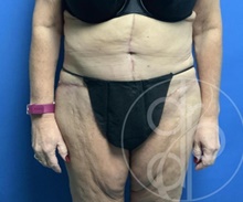 Tummy Tuck After Photo by Danielle DeLuca-Pytell, MD; Troy, MI - Case 47793