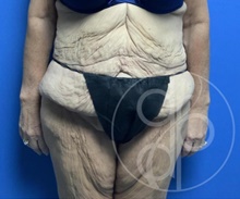 Tummy Tuck Before Photo by Danielle DeLuca-Pytell, MD; Troy, MI - Case 47793