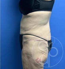 Tummy Tuck After Photo by Danielle DeLuca-Pytell, MD; Troy, MI - Case 47793