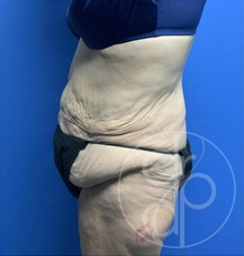 Tummy Tuck Before Photo by Danielle DeLuca-Pytell, MD; Troy, MI - Case 47793