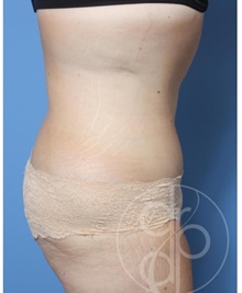 Tummy Tuck After Photo by Danielle DeLuca-Pytell, MD; Troy, MI - Case 47794