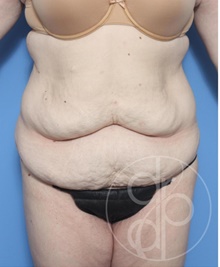 Tummy Tuck Before Photo by Danielle DeLuca-Pytell, MD; Troy, MI - Case 47794