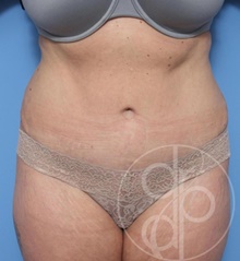 Tummy Tuck After Photo by Danielle DeLuca-Pytell, MD; Troy, MI - Case 47795
