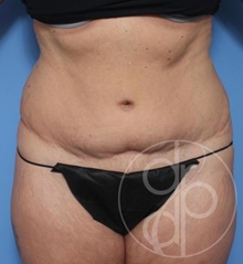 Tummy Tuck Before Photo by Danielle DeLuca-Pytell, MD; Troy, MI - Case 47795