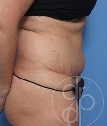 Tummy Tuck Before Photo by Danielle DeLuca-Pytell, MD; Troy, MI - Case 47795