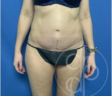 Tummy Tuck After Photo by Danielle DeLuca-Pytell, MD; Troy, MI - Case 47796