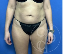 Tummy Tuck Before Photo by Danielle DeLuca-Pytell, MD; Troy, MI - Case 47796